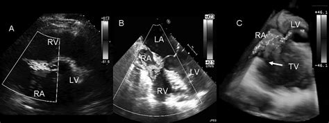 lv to ra shunt|Multimodality Imaging of a Gerbode Defect .